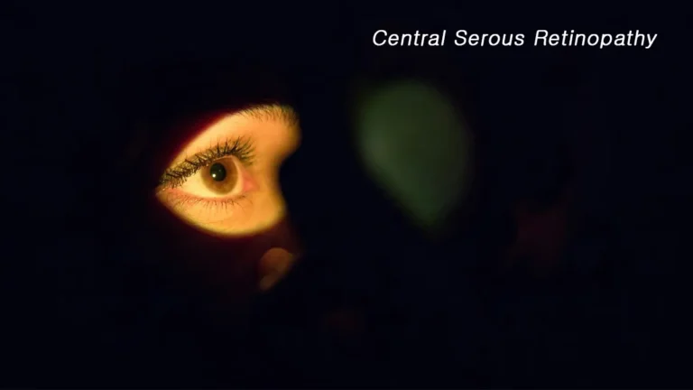 Central Serous Retinopat