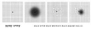 황반변성 유사질환 중심성망막염증상