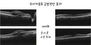 황반 변성 주사 효과