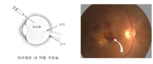 황반변성 안구주사
