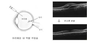 황반변성 주사후 변화